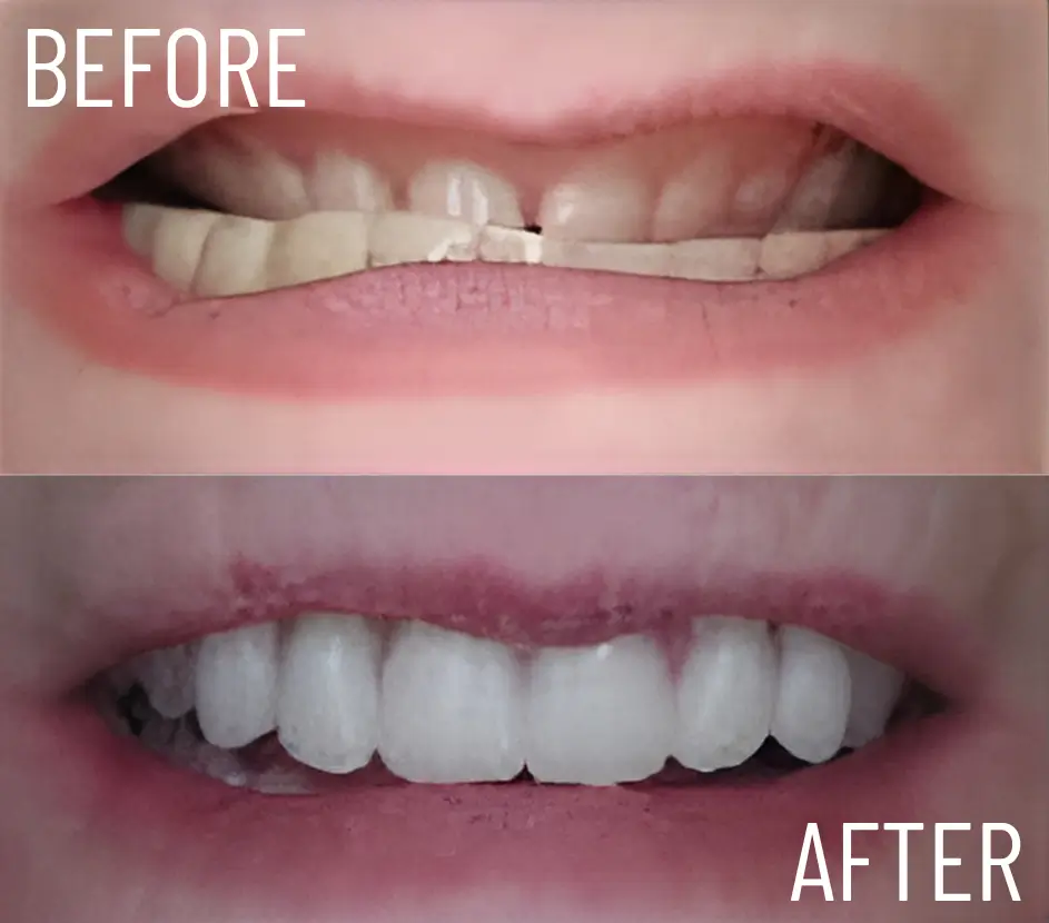 dentures & partial dentures