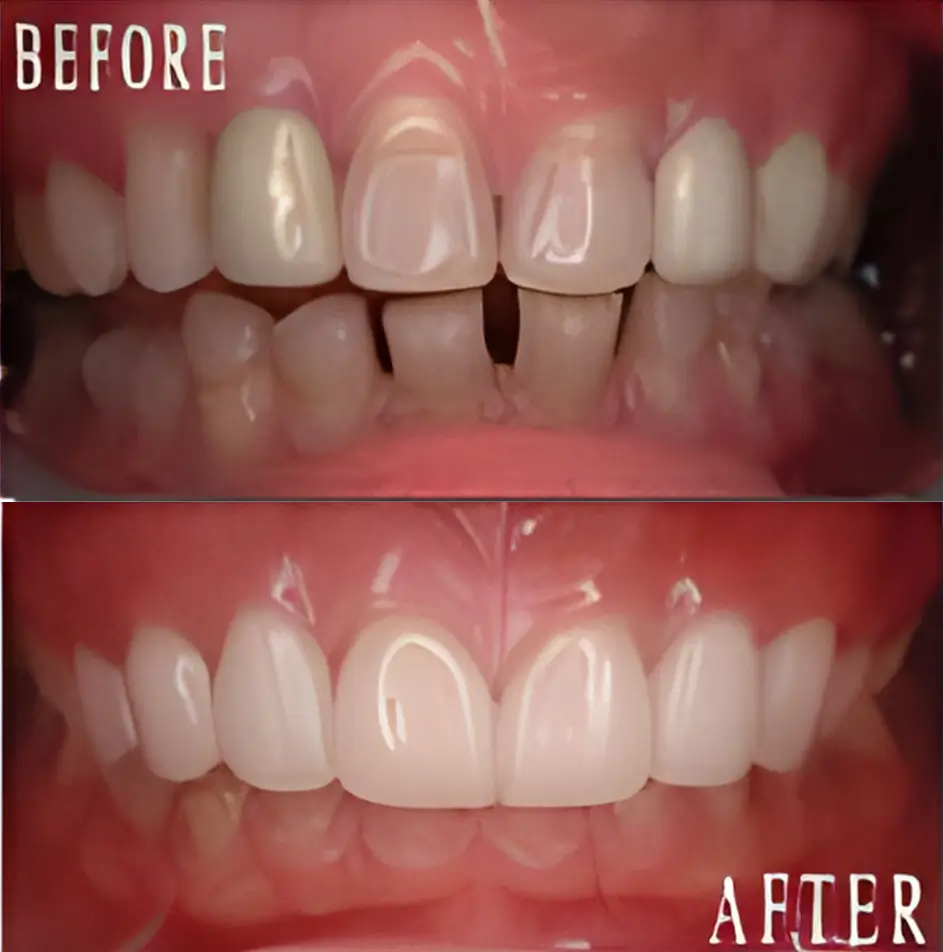 porcelain veneers & porcelain crowns