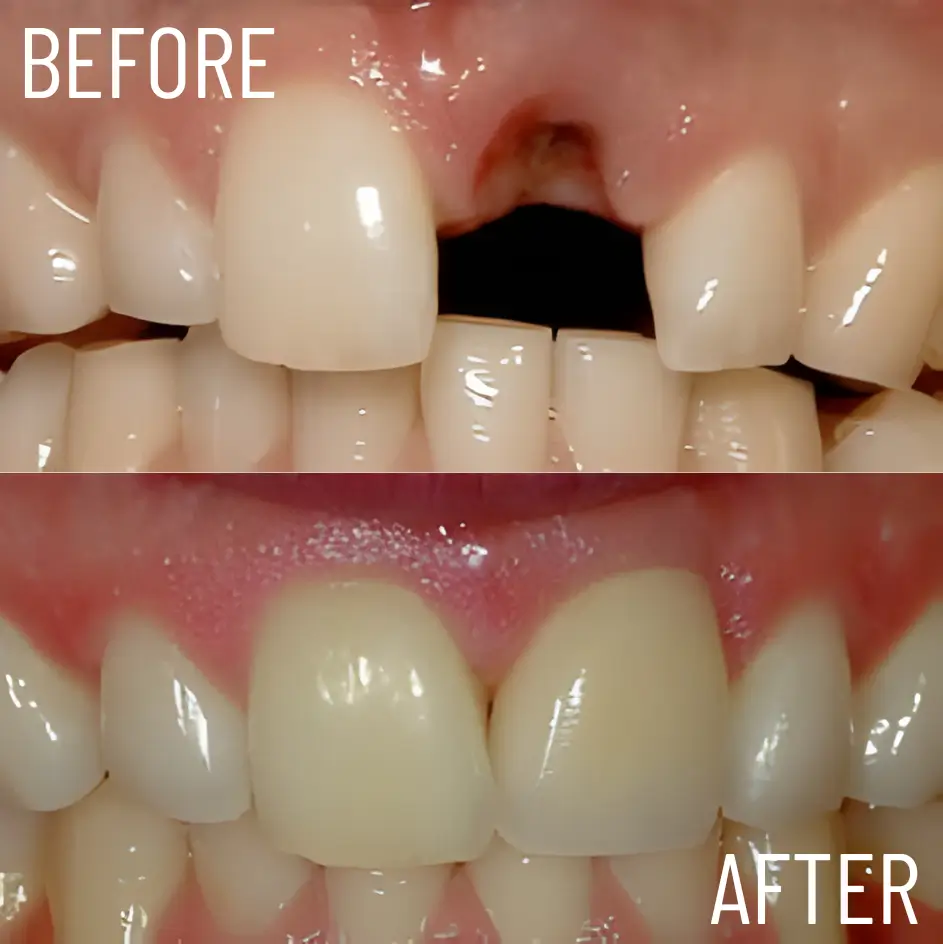 single tooth replacement