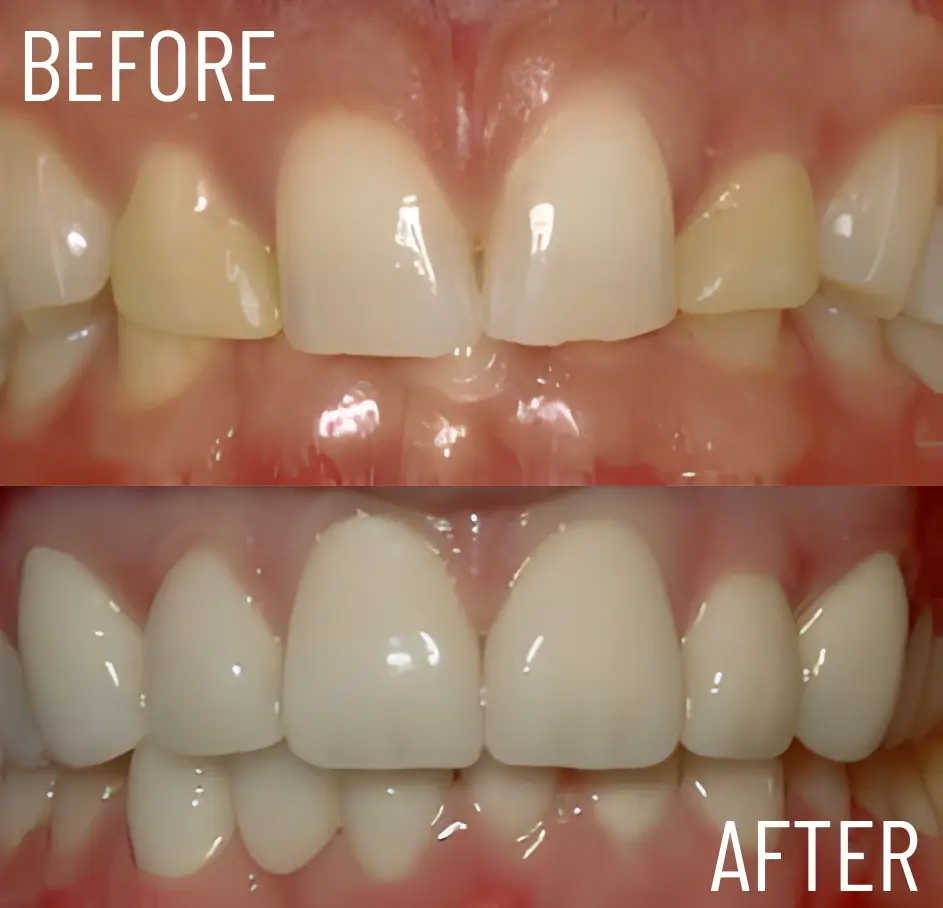 six upper anterior teeth (1)