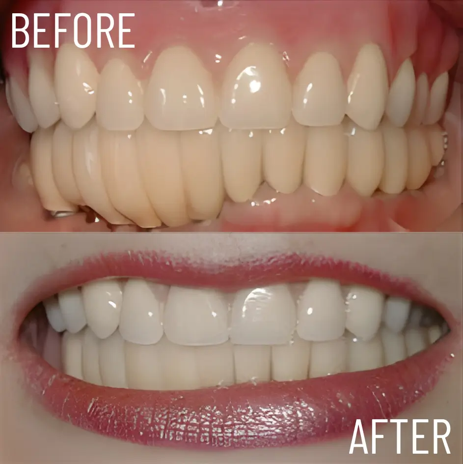 upper and lower arch rehabilitation (2)