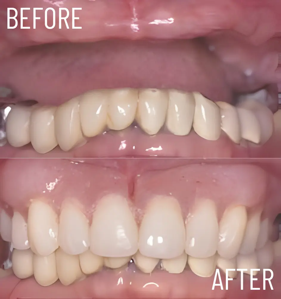 upper and lower arch rehabilitation