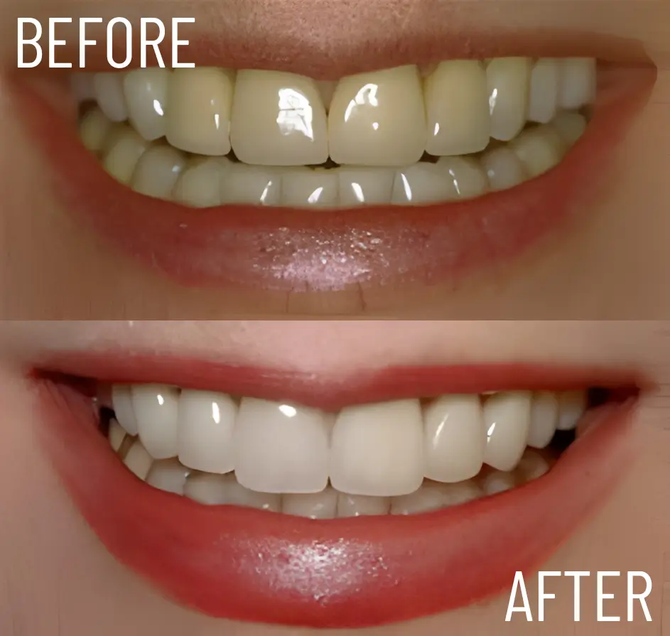 upper anterior crowns (caps)