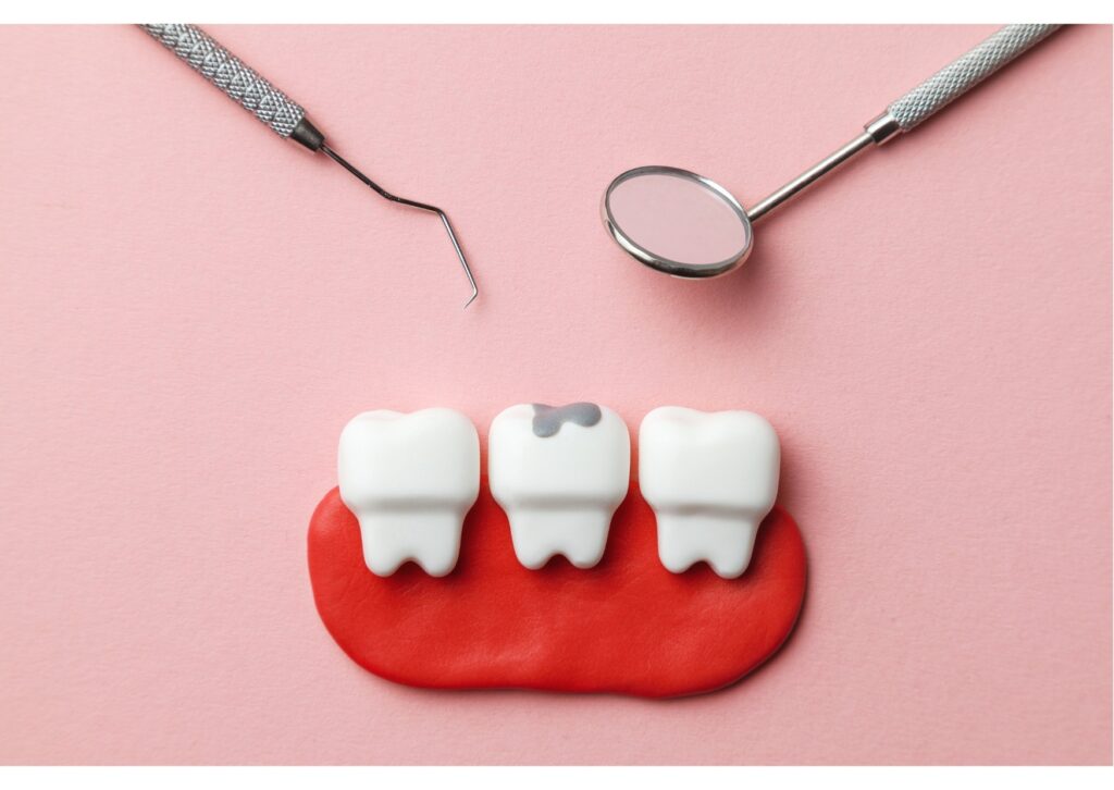 Dental model showing a chipped tooth with dental tools, illustrating bonding vs. veneers repair options.