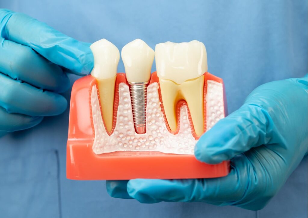 Dental implant model showing a replacement tooth secured by an implant post, illustrating the type of specialist who does dental implants and restores missing teeth.